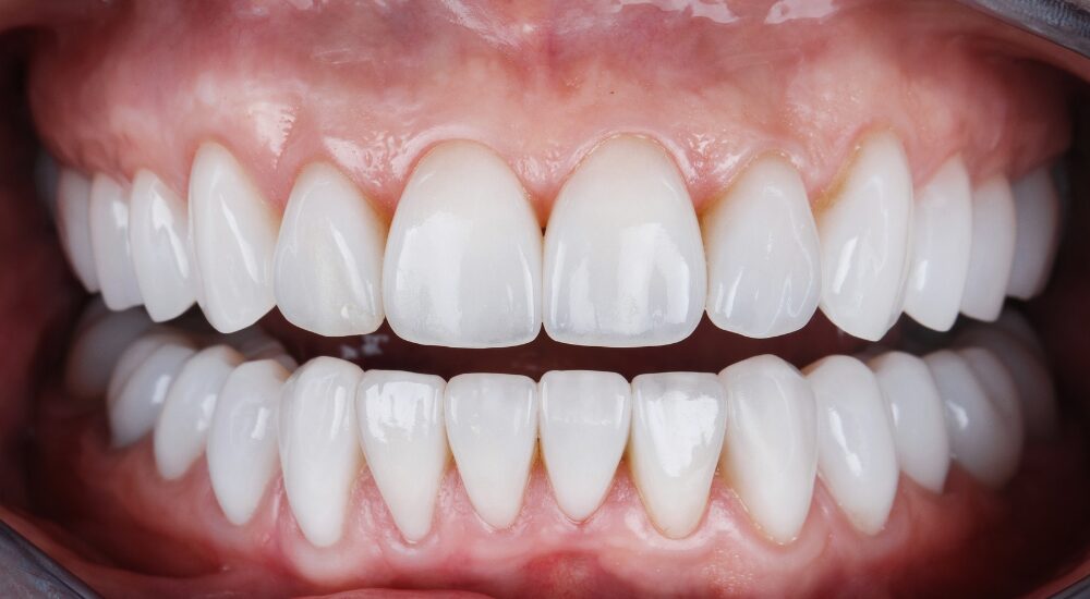 審美歯科セラミック治療について